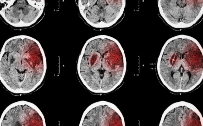 causes of brain injuries